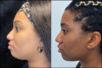 Morpheus8 Before & After Gallery - Patient 326094 - Image 1
