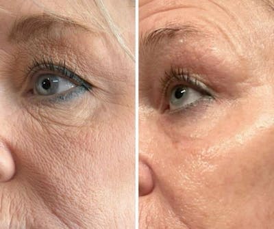 Morpheus8 Before & After Gallery - Patient 170566 - Image 1