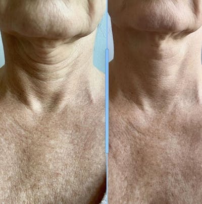 Morpheus8 Before & After Gallery - Patient 343364 - Image 1