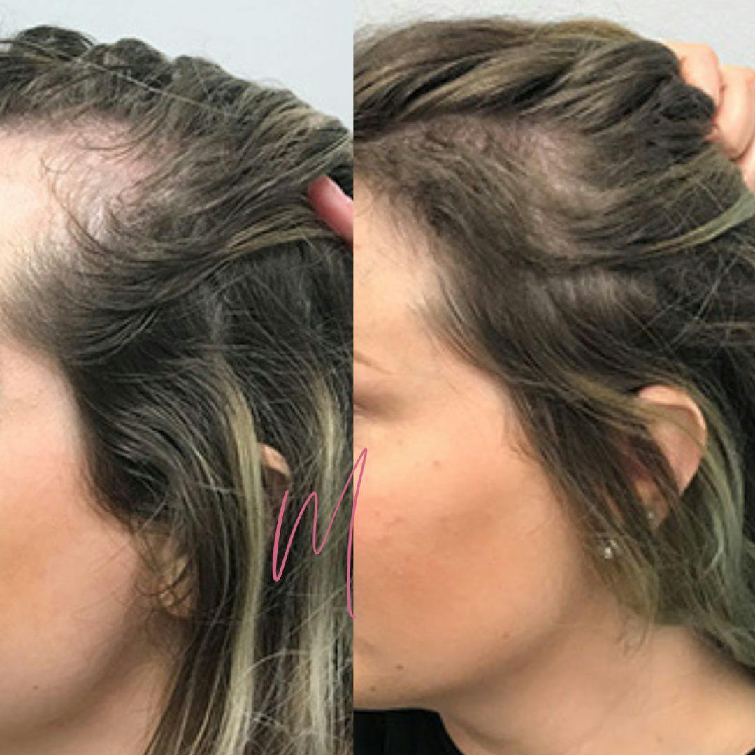 PRP Hair Restoration Before & After Gallery - Patient 651144 - Image 1