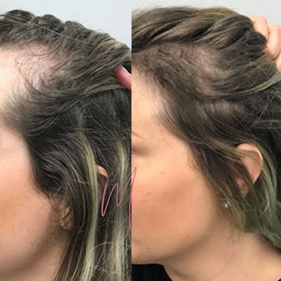 PRP Hair Restoration Before & After Gallery - Patient 651144 - Image 1
