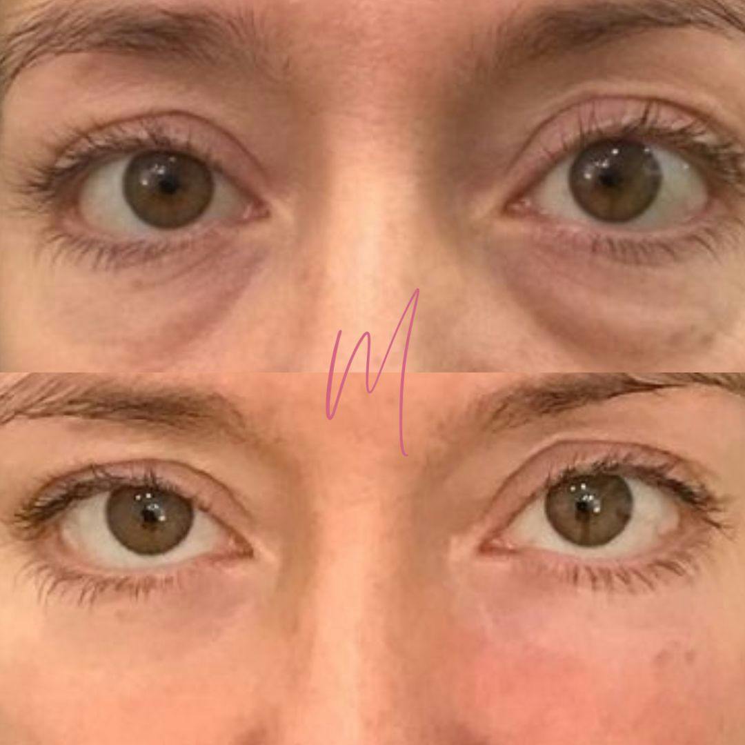 PRP Eye Rejuvenation Before & After Gallery - Patient 256882 - Image 1