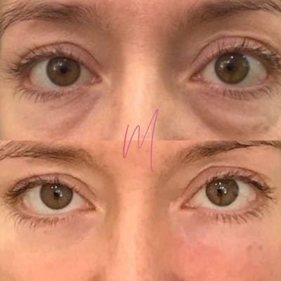 PRP Eye Rejuvenation Before & After Gallery - Patient 256882 - Image 1