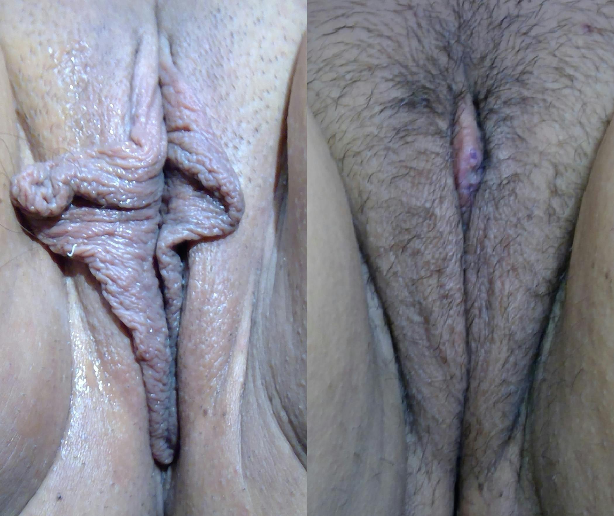 Labiaplasty Before & After Gallery - Patient 411161 - Image 1