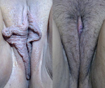 Labiaplasty Before & After Gallery - Patient 411161 - Image 1