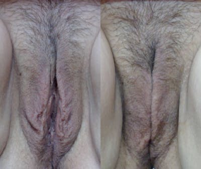 Mona Lisa Touch Before & After Gallery - Patient 372429 - Image 1