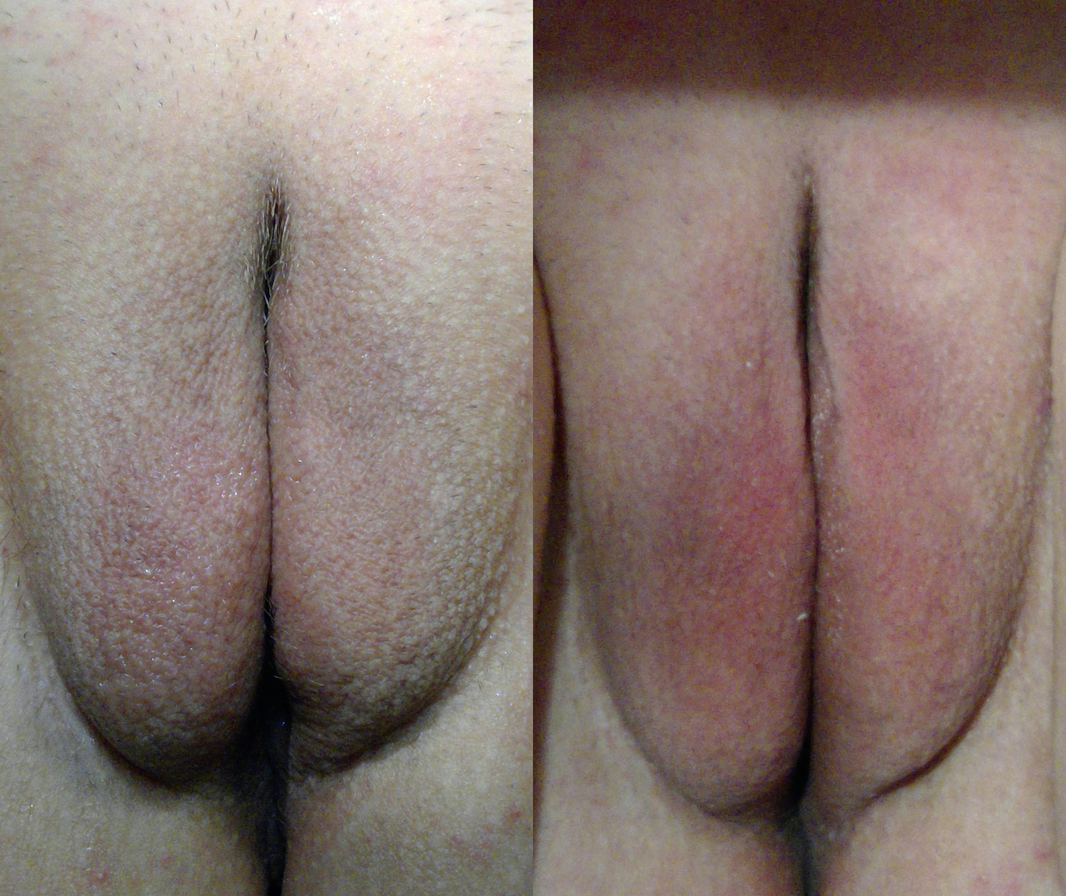 Morpheus8 V Before & After Gallery - Patient 311484 - Image 1