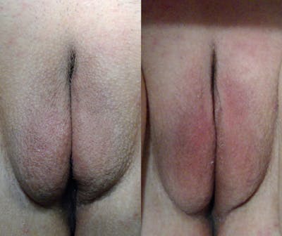 Morpheus8 V Before & After Gallery - Patient 311484 - Image 1