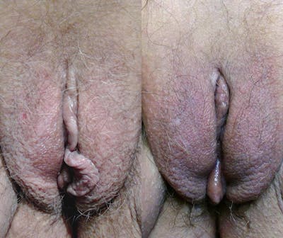 Votiva Before & After Gallery - Patient 197467 - Image 1