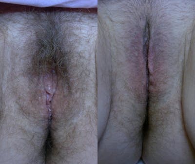 Votiva Before & After Gallery - Patient 383332 - Image 1