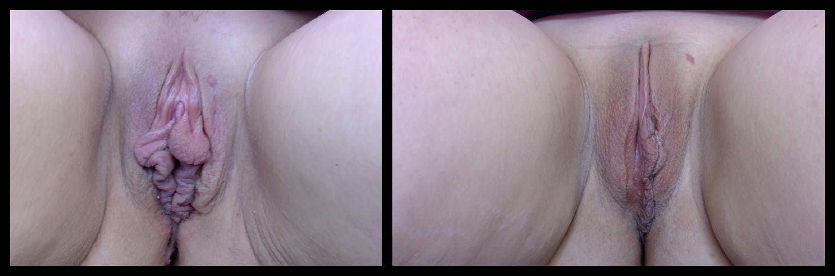 Labiaplasty Before & After Gallery - Patient 700303 - Image 1