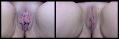 Labiaplasty Before & After Gallery - Patient 700303 - Image 1