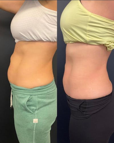 EvolveX Before & After Gallery - Patient 300506 - Image 1