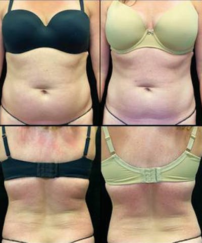 EvolveX Before & After Gallery - Patient 685734 - Image 1