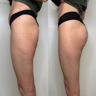 EvolveX Before & After Gallery - Patient 404742 - Image 1