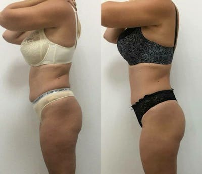 Weight Management Before & After Gallery - Patient 216187 - Image 1