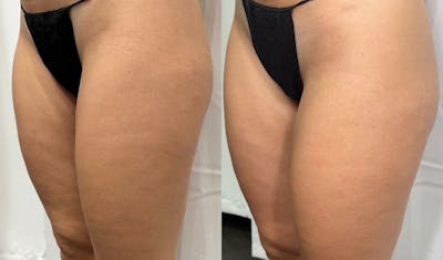 Weight Management Before & After Gallery - Patient 157764 - Image 1