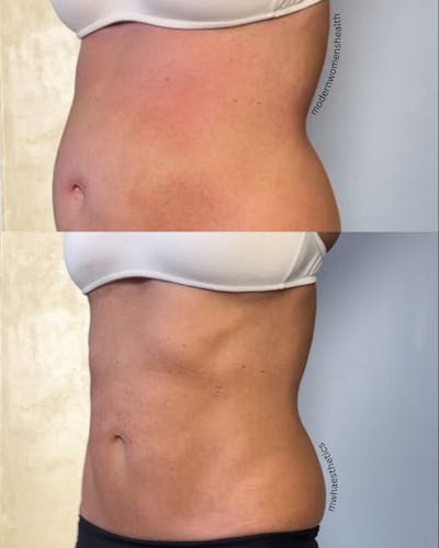 Weight Management Before & After Gallery - Patient 339055 - Image 1