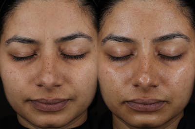 Diamond Glow Before & After Gallery - Patient 570440 - Image 1