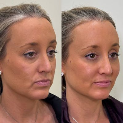 PRP Eye Rejuvenation Before & After Gallery - Patient 428186 - Image 1