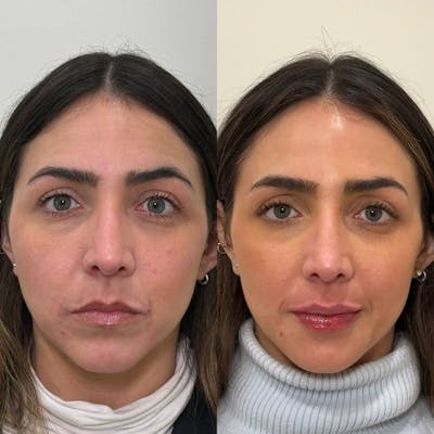 PRP Eye Rejuvenation Before & After Gallery - Patient 154953 - Image 1