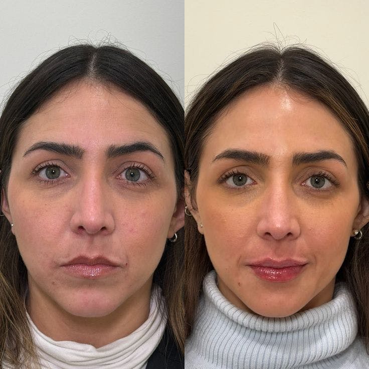 PRP Eye Rejuvenation Before & After Gallery - Patient 154953 - Image 1