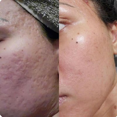 Morpheus8 Before & After Gallery - Patient 271625 - Image 1