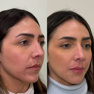 Dermal Fillers Before & After Gallery - Patient 282429 - Image 1