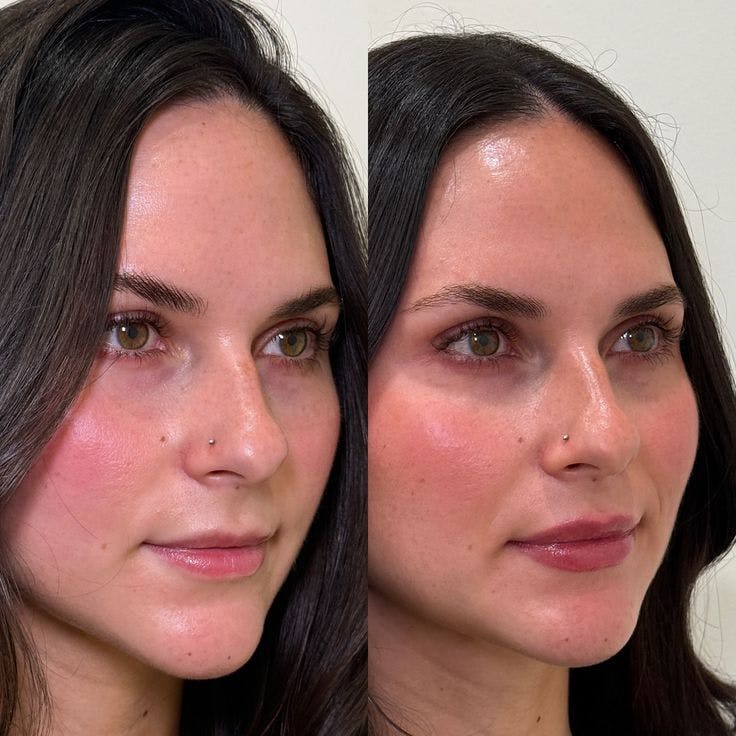 Dermal Fillers Before & After Gallery - Patient 828667 - Image 2