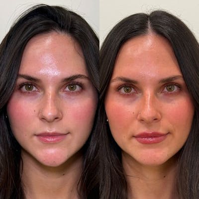 Dermal Fillers Before & After Gallery - Patient 828667 - Image 1