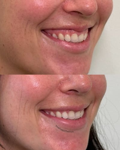 BOTOX/Dysport Before & After Gallery - Patient 182357 - Image 1