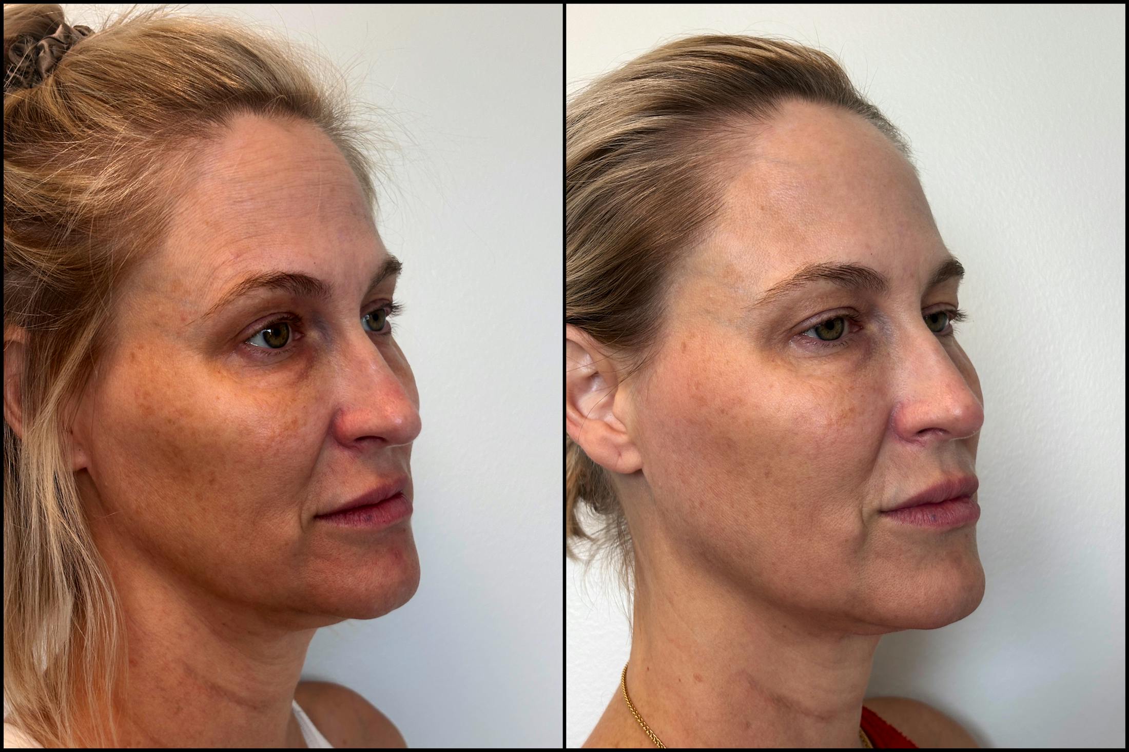 Dermal Fillers Before & After Gallery - Patient 389872 - Image 1