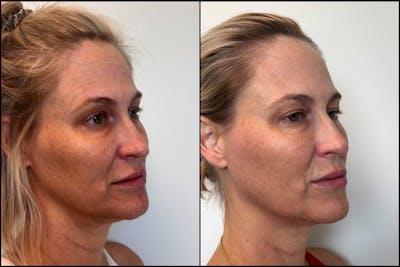 Dermal Fillers Before & After Gallery - Patient 389872 - Image 1