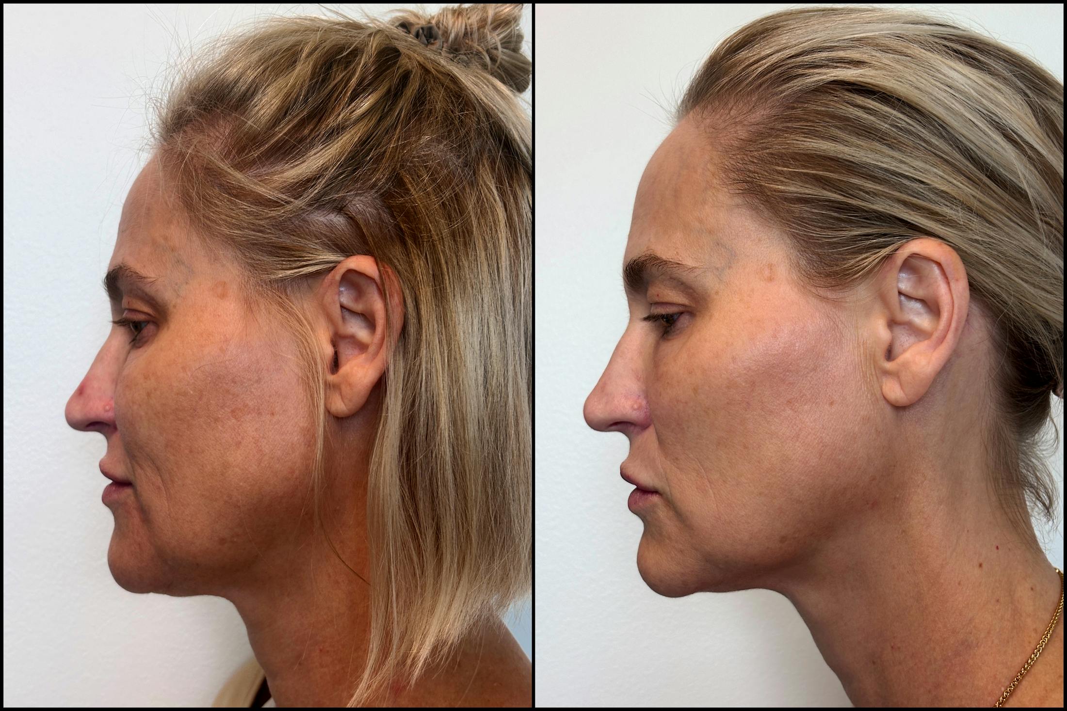 Dermal Fillers Before & After Gallery - Patient 389872 - Image 4