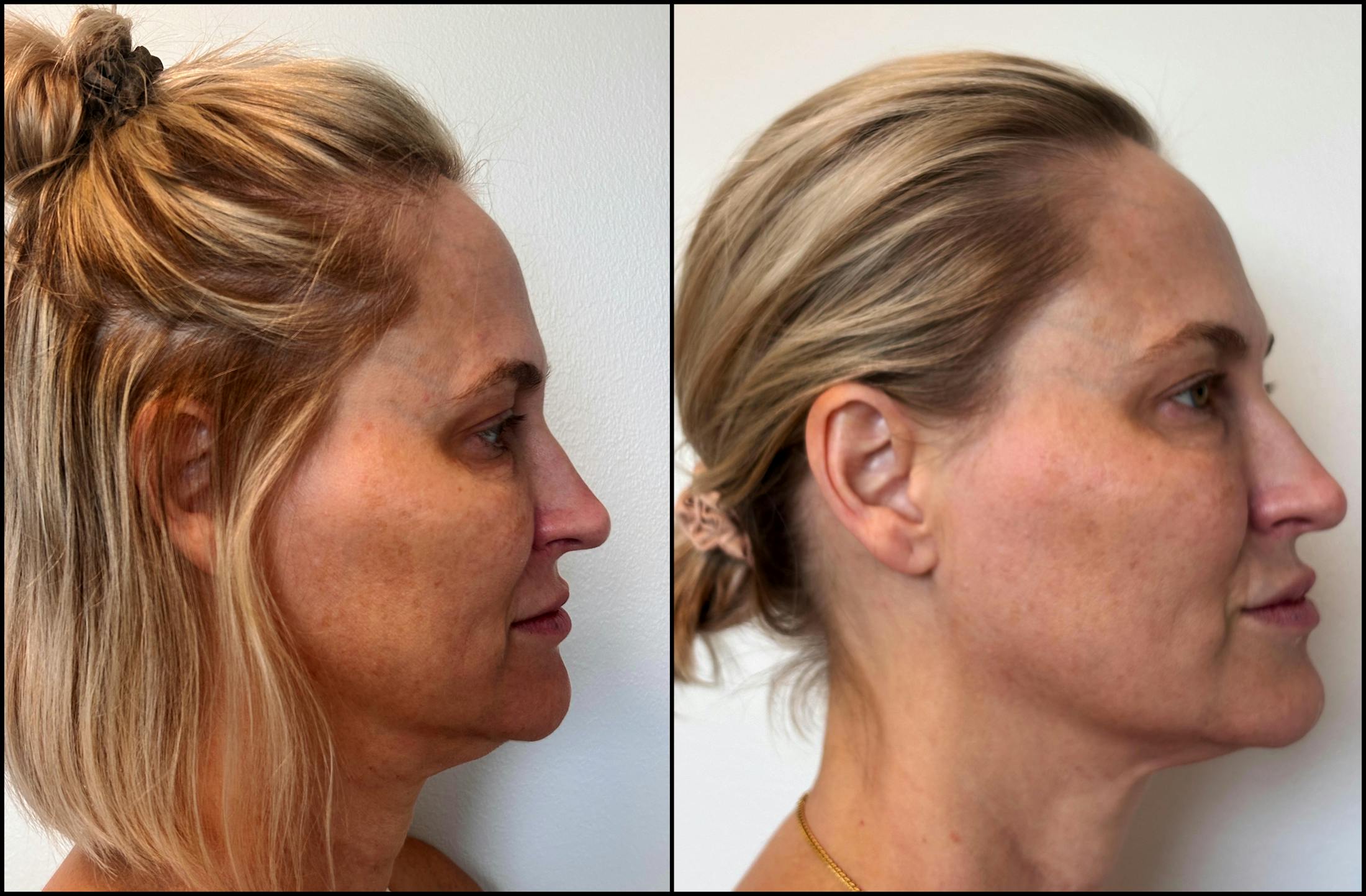 Dermal Fillers Before & After Gallery - Patient 389872 - Image 2