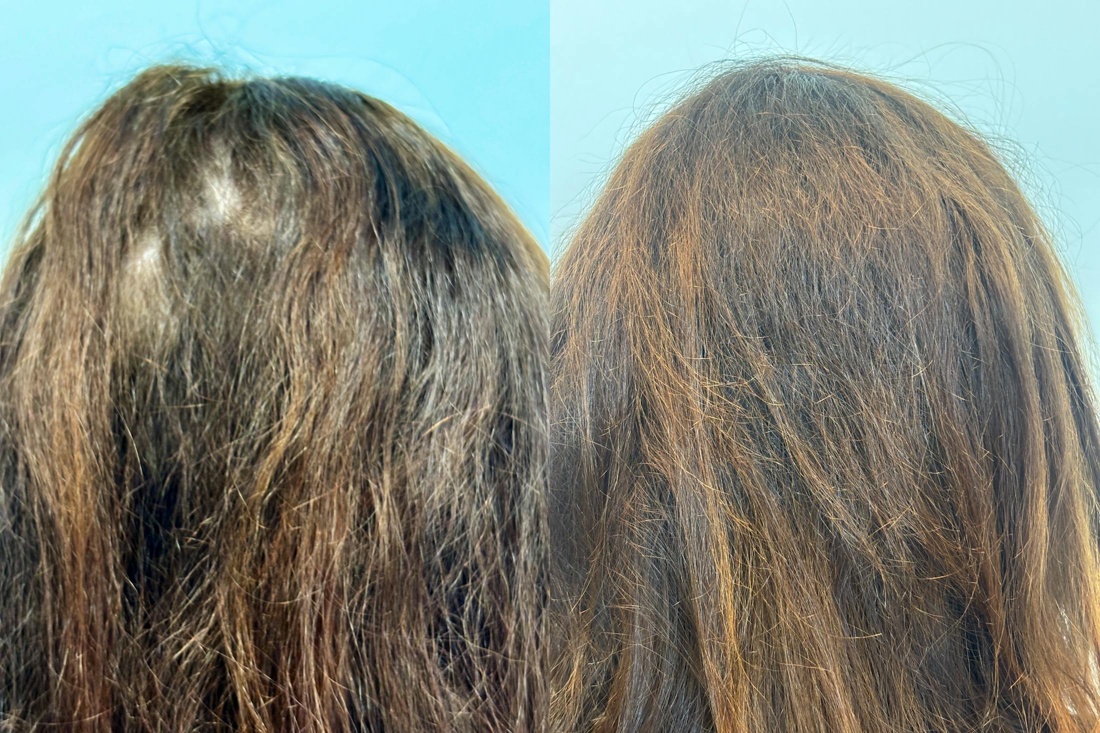 PRP Hair Restoration Before & After Gallery - Patient 166969 - Image 1