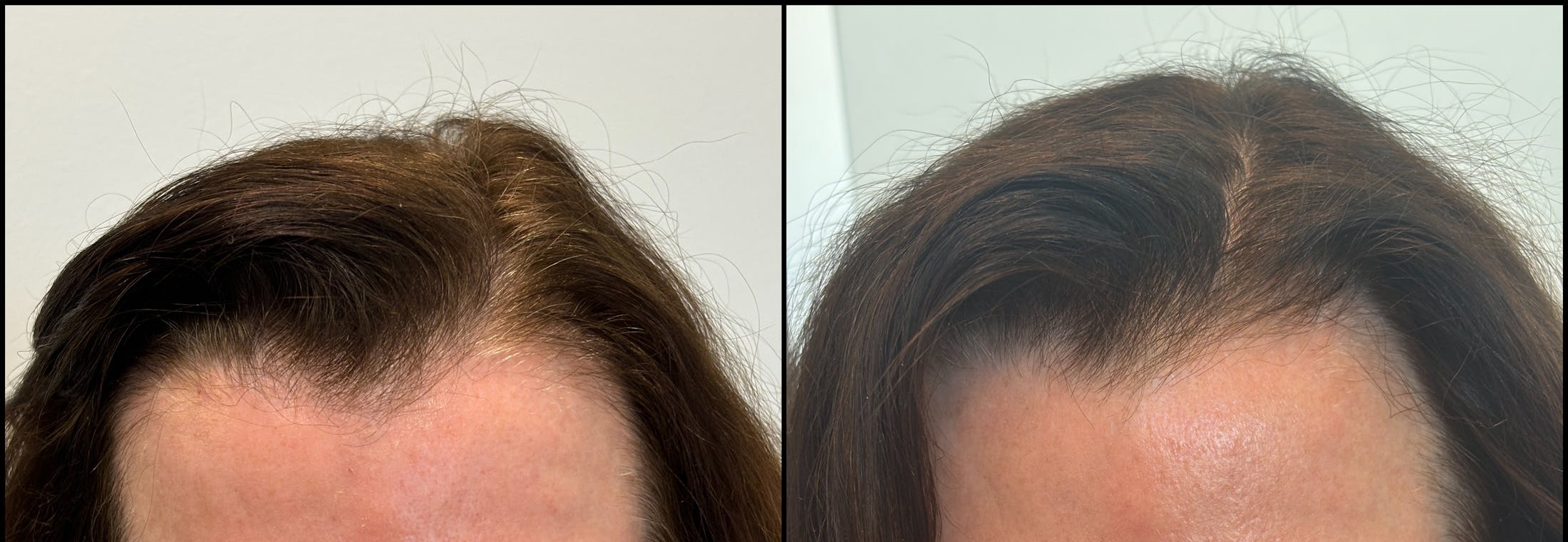 PRP Hair Restoration Before & After Gallery - Patient 166969 - Image 2