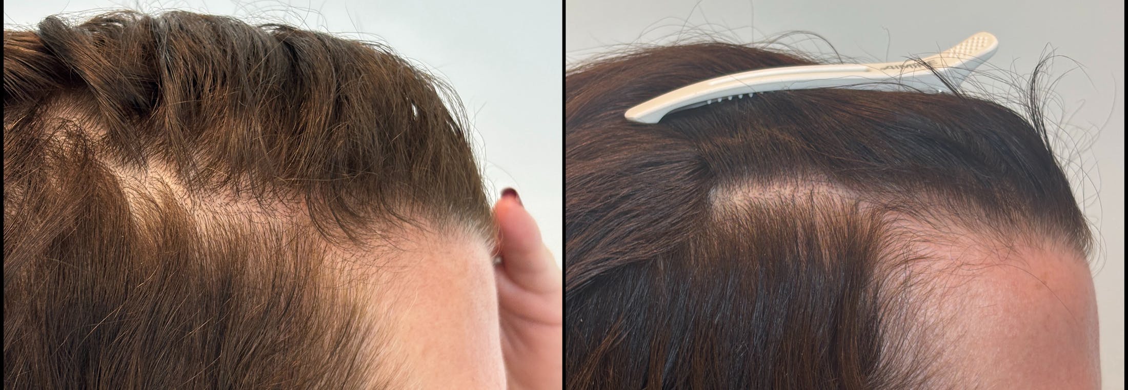 PRP Hair Restoration Before & After Gallery - Patient 166969 - Image 3