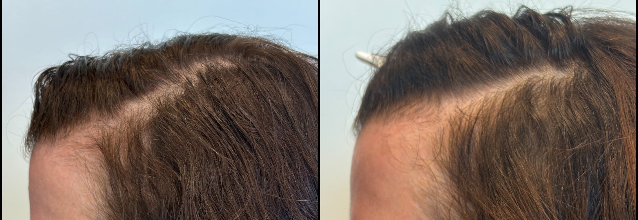 PRP Hair Restoration Before & After Gallery - Patient 166969 - Image 4