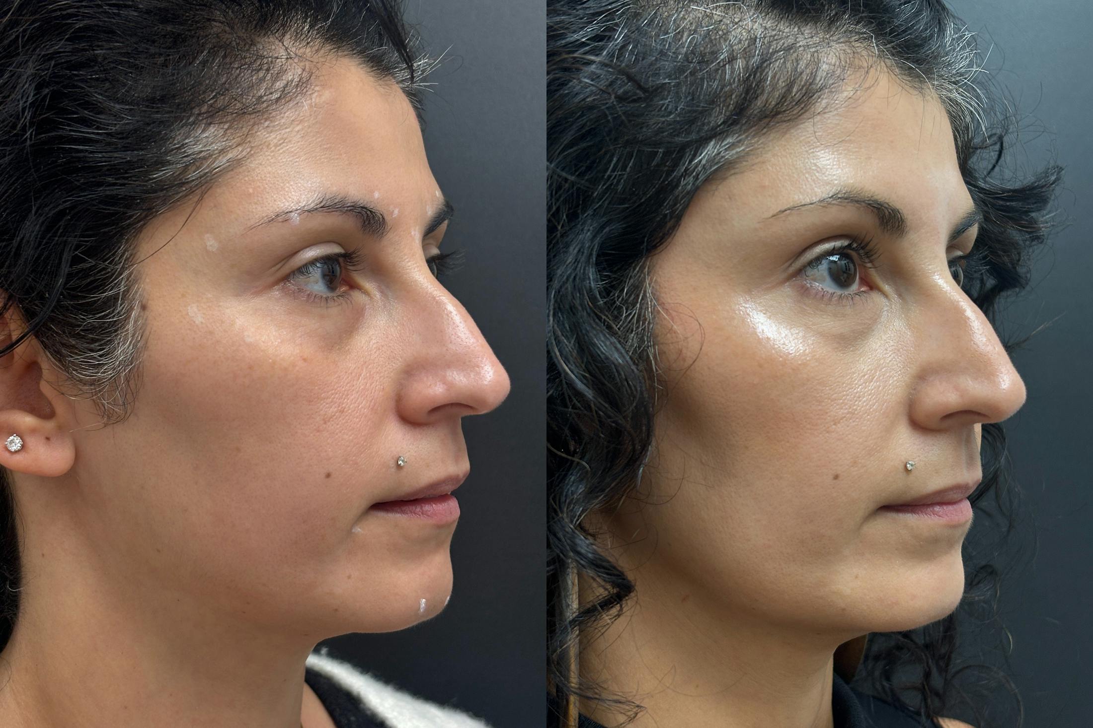 BOTOX/Dysport Before & After Gallery - Patient 306134 - Image 2