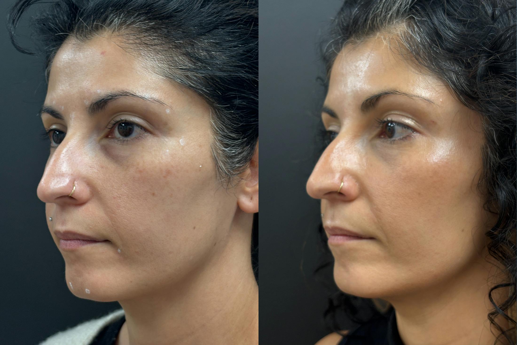 BOTOX/Dysport Before & After Gallery - Patient 306134 - Image 3