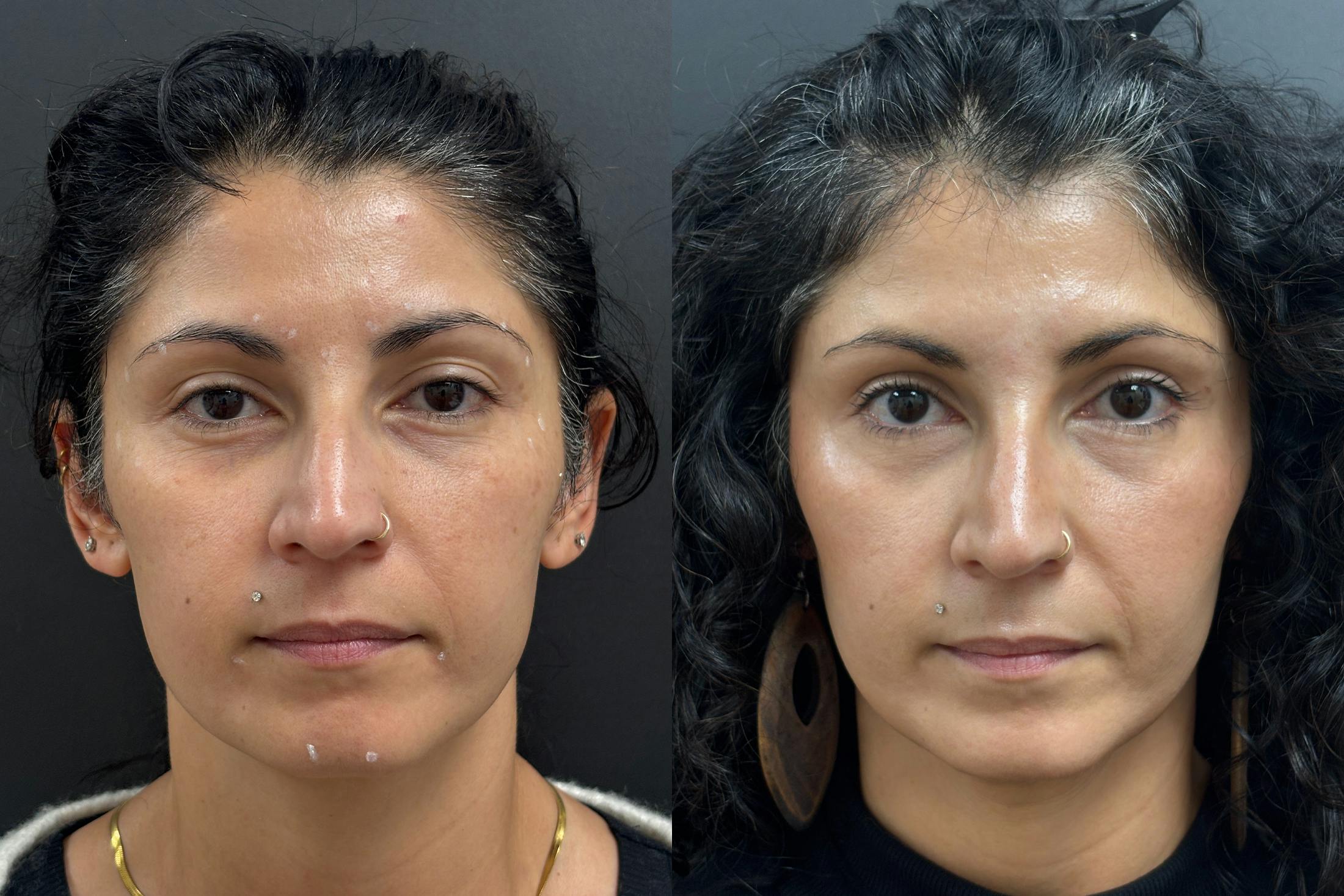 BOTOX/Dysport Before & After Gallery - Patient 306134 - Image 1