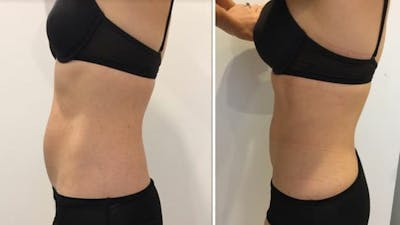 Weight Management Before & After Gallery - Patient 409714 - Image 1