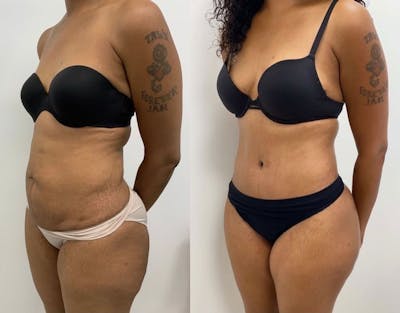 Weight Management Before & After Gallery - Patient 332901 - Image 1