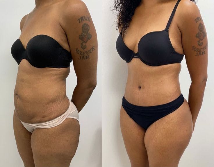 Weight Management Before & After Gallery - Patient 332901 - Image 1