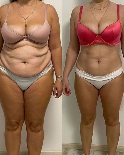 Weight Management Before & After Gallery - Patient 234109 - Image 1