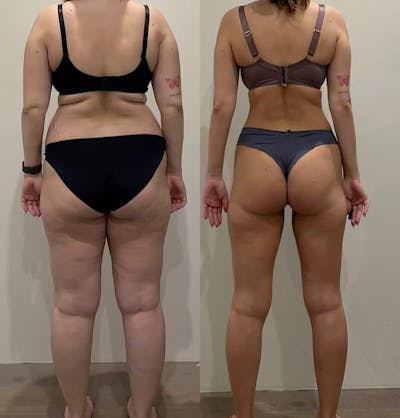 Weight Management Before & After Gallery - Patient 116467 - Image 1