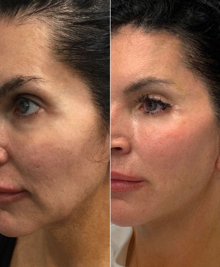 Dermal Fillers Before & After Gallery - Patient 336141 - Image 1