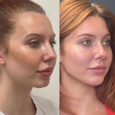 Dermal Fillers Before & After Gallery - Patient 289763 - Image 1