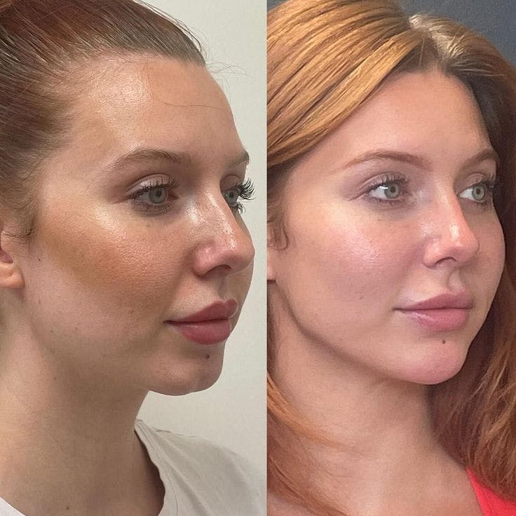 Dermal Fillers Before & After Gallery - Patient 289763 - Image 1